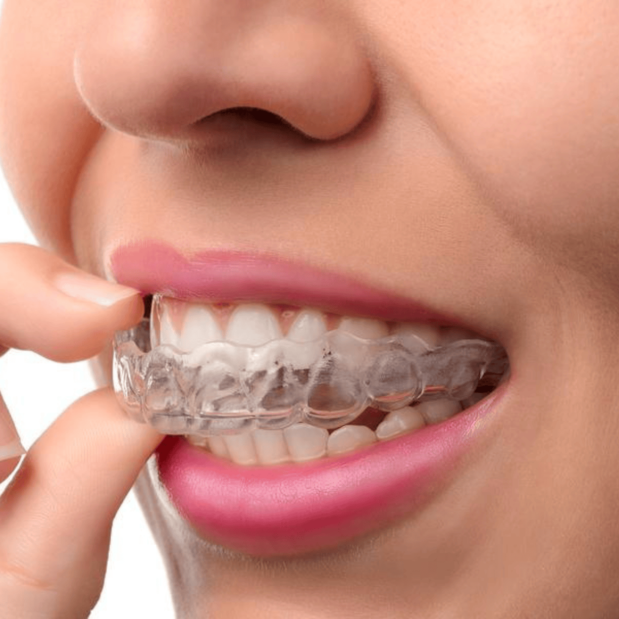 Clear removable aligner over teeth